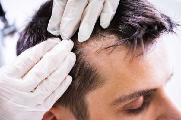 How to Effectively Treat Scalp Psoriasis in Older Patients